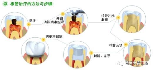 最新解答方案，牙髓炎的药物治疗与选择——UHD33.45.26关键词解析，可靠性策略解析_储蓄版78.91.78